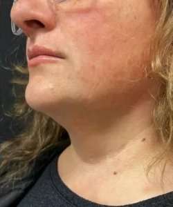 Smartlipo Vaser Lipo Before & After Patient #460