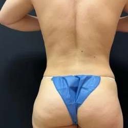 Smartlipo Vaser Lipo Before & After Patient #463