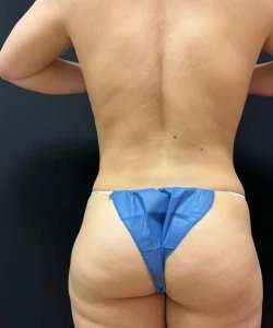 Smartlipo Vaser Lipo Before & After Patient #463