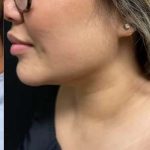 Smartlipo Vaser Lipo Before & After Patient #466