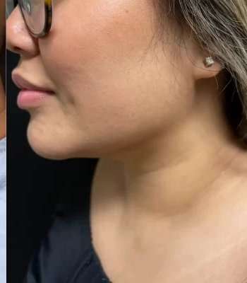 Smartlipo Vaser Lipo Before & After Patient #466