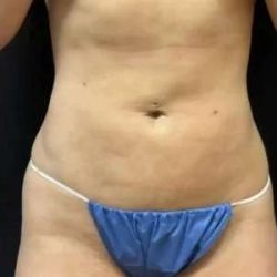 Smartlipo Vaser Lipo Before & After Patient #475