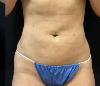 Smartlipo Vaser Lipo Before & After Patient #475