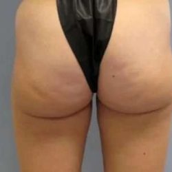 Smartlipo Vaser Lipo Before & After Patient #494