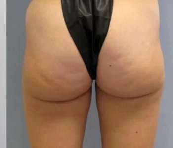 Smartlipo Vaser Lipo Before & After Patient #494