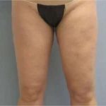 Smartlipo Vaser Lipo Before & After Patient #499