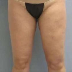 Smartlipo Vaser Lipo Before & After Patient #499