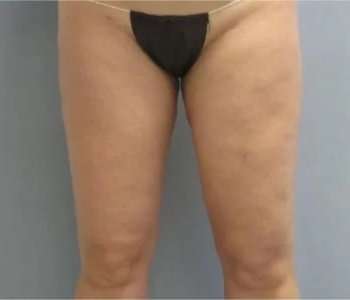 Smartlipo Vaser Lipo Before & After Patient #499