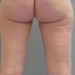 Smartlipo Vaser Lipo Before & After Patient #502