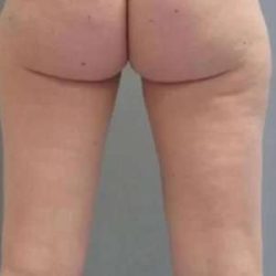 Smartlipo Vaser Lipo Before & After Patient #502