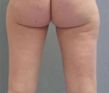 Smartlipo Vaser Lipo Before & After Patient #502