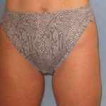 Smartlipo Vaser Lipo Before & After Patient #505