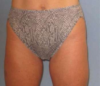 Smartlipo Vaser Lipo Before & After Patient #505