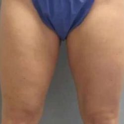 Smartlipo Vaser Lipo Before & After Patient #508
