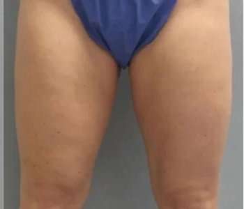 Smartlipo Vaser Lipo Before & After Patient #508