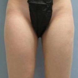 Smartlipo Vaser Lipo Before & After Patient #511