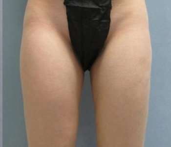 Smartlipo Vaser Lipo Before & After Patient #511