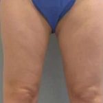 Smartlipo Vaser Lipo Before & After Patient #516