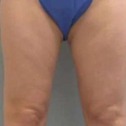 Smartlipo Vaser Lipo Before & After Patient #516