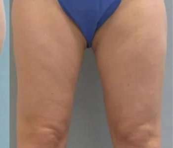 Smartlipo Vaser Lipo Before & After Patient #516