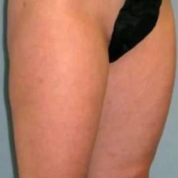 Smartlipo Vaser Lipo Before & After Patient #519