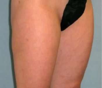 Smartlipo Vaser Lipo Before & After Patient #519