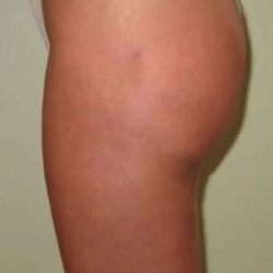 Smartlipo Vaser Lipo Before & After Patient #522