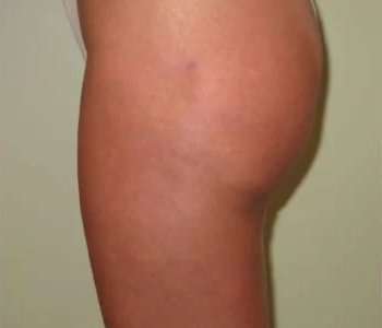 Smartlipo Vaser Lipo Before & After Patient #522