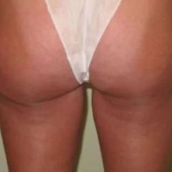 Smartlipo Vaser Lipo Before & After Patient #525