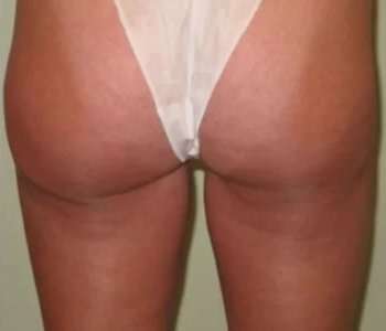 Smartlipo Vaser Lipo Before & After Patient #525