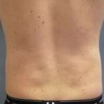 Smartlipo Vaser Lipo Before & After Patient #528