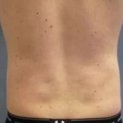 Smartlipo Vaser Lipo Before & After Patient #528