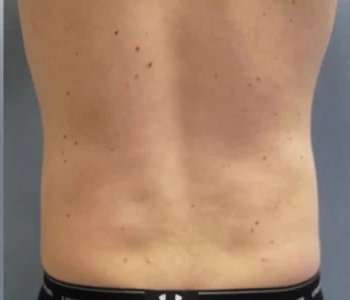 Smartlipo Vaser Lipo Before & After Patient #528