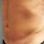 Smartlipo Vaser Lipo Before & After Patient #531