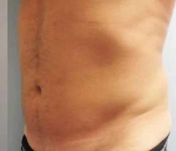 Smartlipo Vaser Lipo Before & After Patient #531