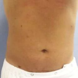 Smartlipo Vaser Lipo Before & After Patient #536