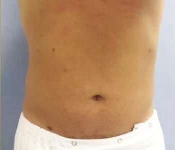 Smartlipo Vaser Lipo Before & After Patient #536