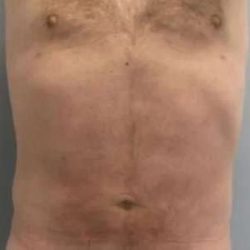 Smartlipo Vaser Lipo Before & After Patient #539