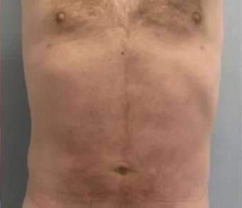 Gynecomastia Before & After Patient #2290