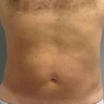 Smartlipo Vaser Lipo Before & After Patient #544