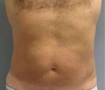 Smartlipo Vaser Lipo Before & After Patient #544