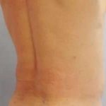 Smartlipo Vaser Lipo Before & After Patient #547