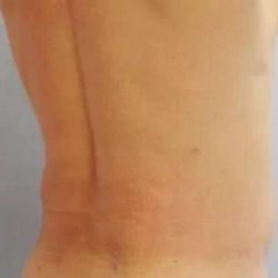 Smartlipo Vaser Lipo Before & After Patient #547