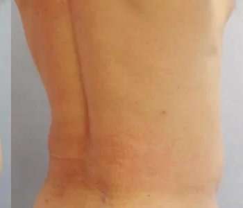 Smartlipo Vaser Lipo Before & After Patient #547