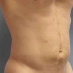 Smartlipo Vaser Lipo Before & After Patient #550