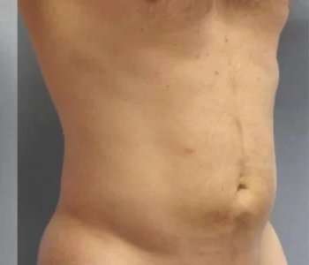 Smartlipo Vaser Lipo Before & After Patient #550