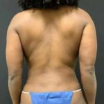 Smartlipo Vaser Lipo Before & After Patient #553