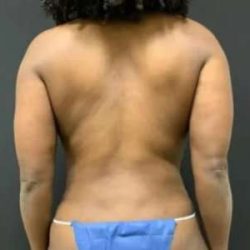 Smartlipo Vaser Lipo Before & After Patient #553