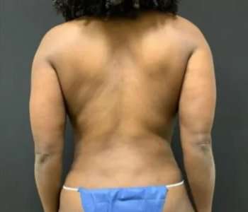 Smartlipo Vaser Lipo Before & After Patient #553