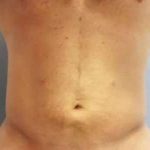 Smartlipo Vaser Lipo Before & After Patient #556